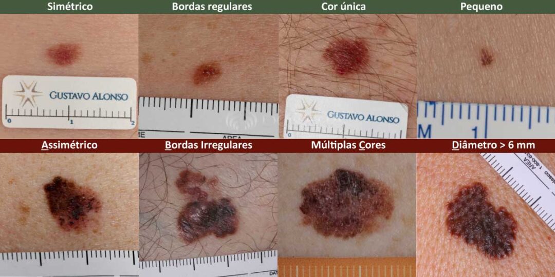 Neo Rugoso Pintas ou sinais benignos (nevo melanocítico)