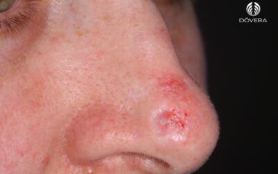 Carcinoma basocelular esclerodermiforme ou infiltrativo