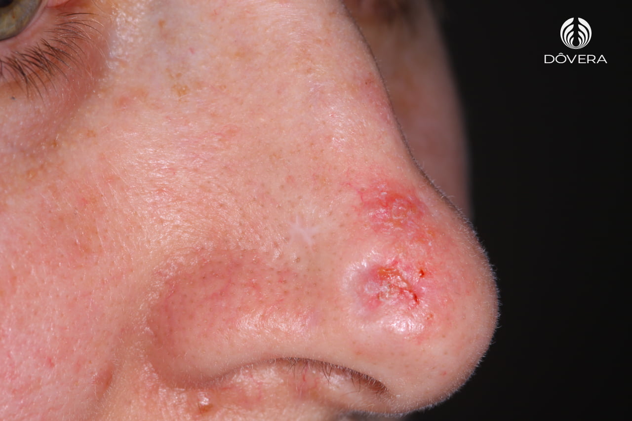 Carcinoma Basocelular esclerodermiforme em nariz