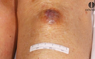 Dermatofibrosarcoma protuberans