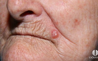 Carcinoma basocelular nodular
