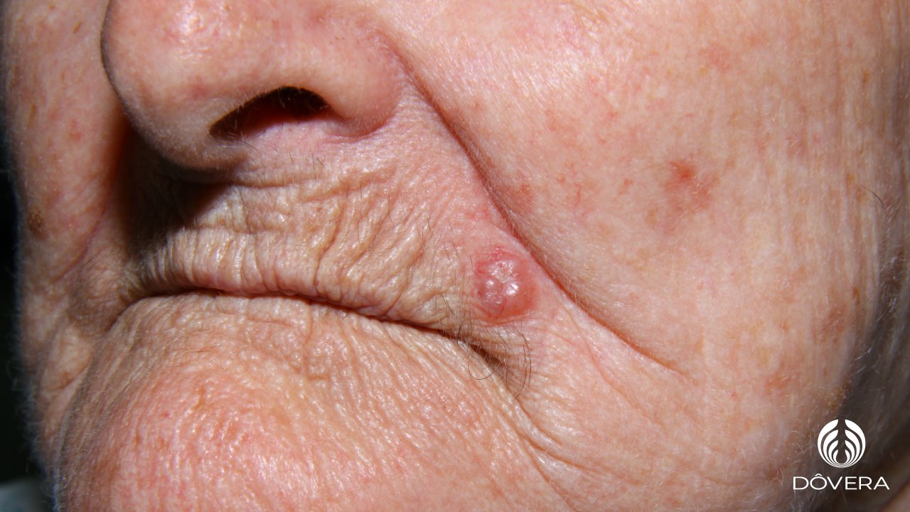 Carcinoma Basocelular Nodular em face.