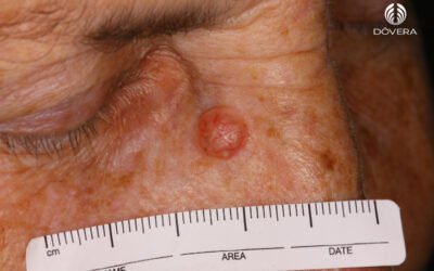 Carcinoma basocelular