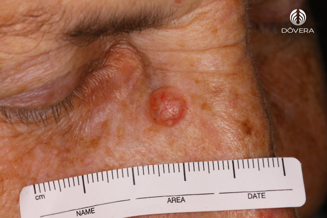 Carcinoma basocleular nodular em face