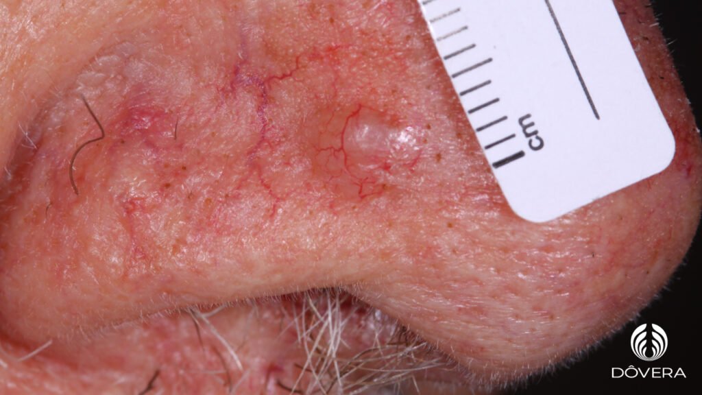 Carcinoma basocelular nodular Diagnóstico e Tratamento Carcinoma basocelular nodular Diagnóstico e Tratamento