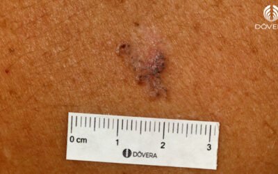 Carcinoma basocelular superficial
