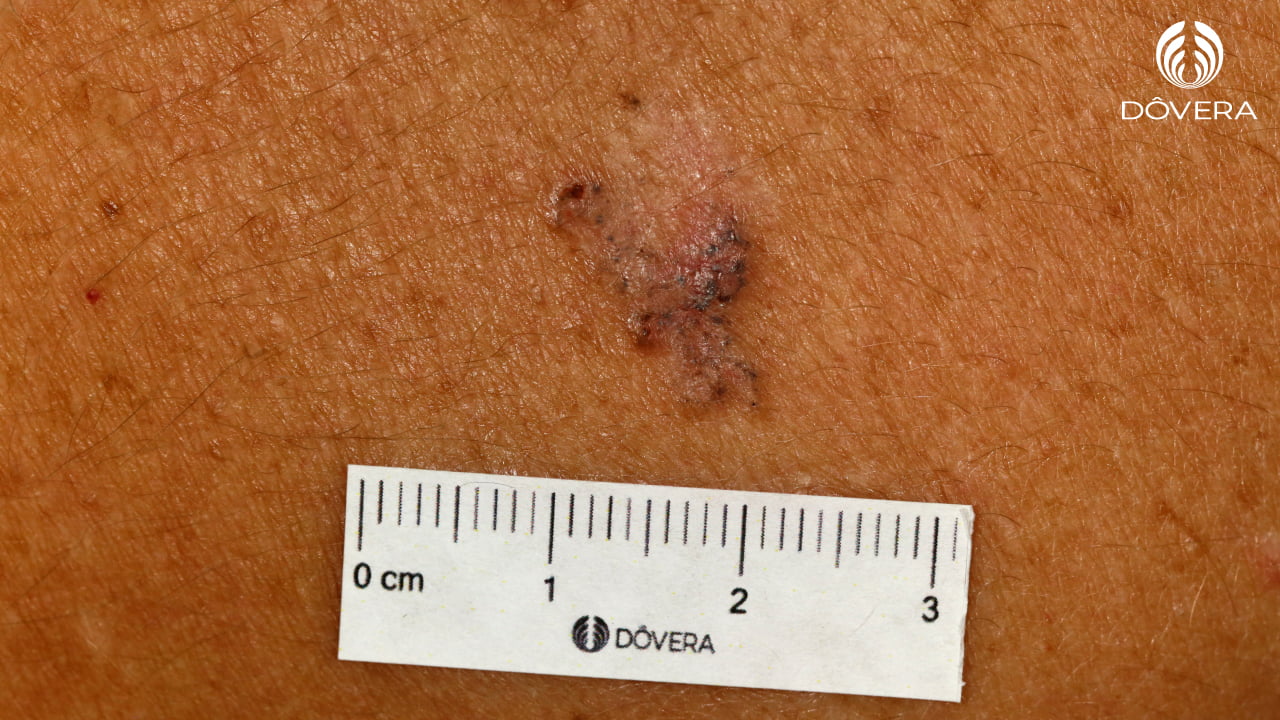 Carcinoma Basocelular superficial pigmentado