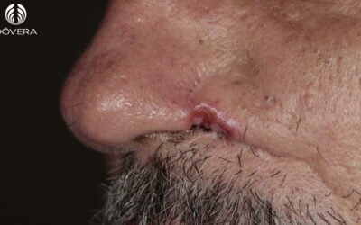 Carcinoma basoescamoso ou metatípico