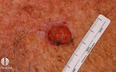 Carcinoma de Merkel