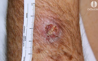Carcinoma espinocelular
