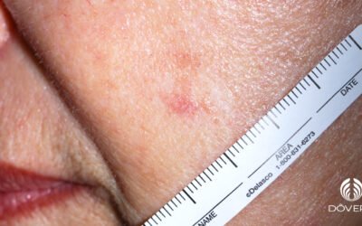 Carcinoma espinocelular superficialmente invasivo