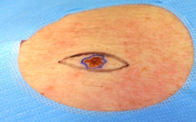 Cirurgia de câncer de pele