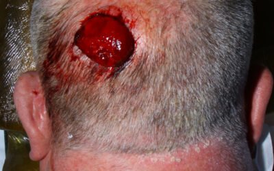 Fibroxantoma atípico