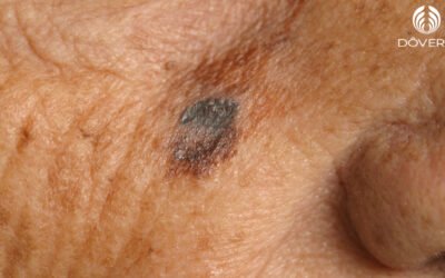 Lentigo Maligno Melanoma