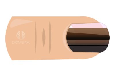 Mancha escura na unha