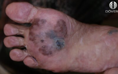 Melanoma Acral
