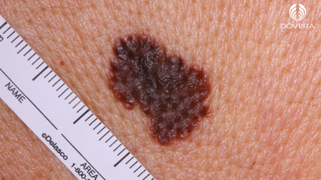 Melanoma Maligno