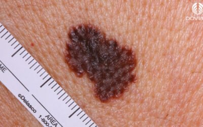 Melanoma