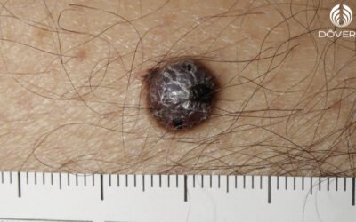 Melanoma Nodular