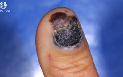 Melanoma subungueal