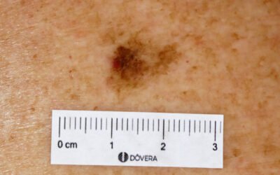 Melanoma in situ