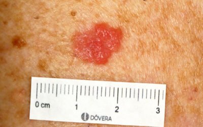 Tratamento do carcinoma basocelular