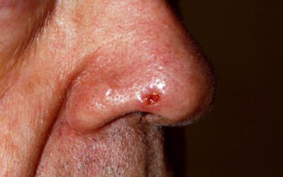 Tratamento do carcinoma espinocelular