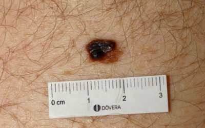 Tratamento do melanoma