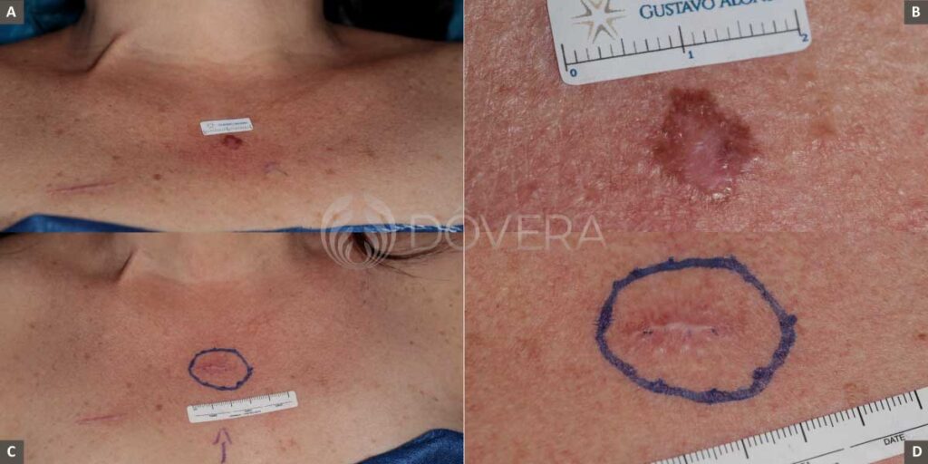 Tratamento do melanoma Dôvera