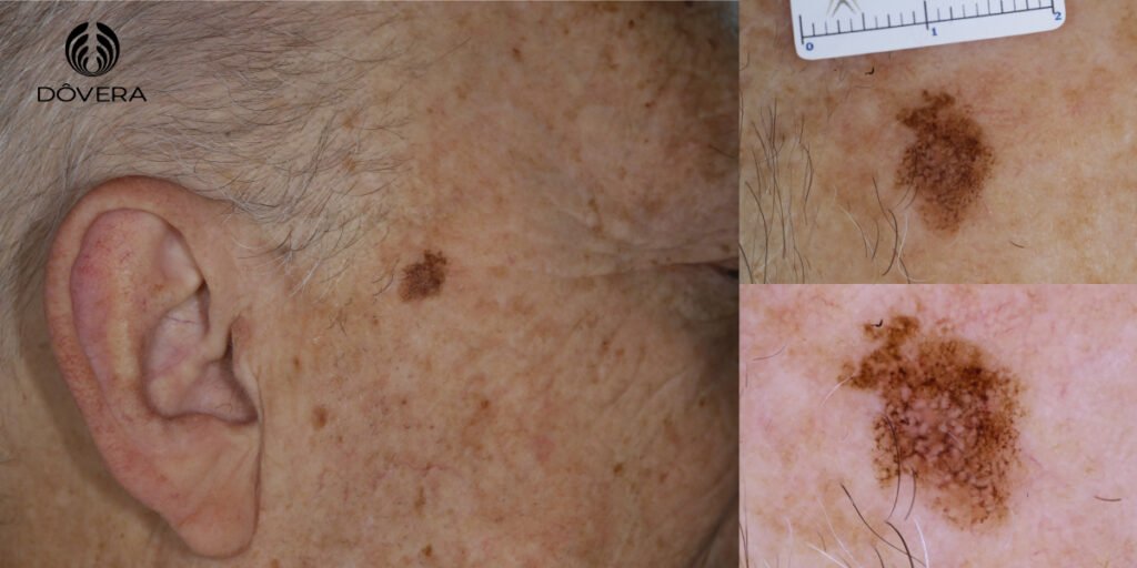 Lentigo Maligno melanoma em face: dermatoscopia