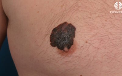 Melanoma Extensivo Superficial