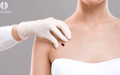 Será que é um melanoma?