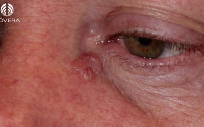 Fotos de carcinoma basocelular