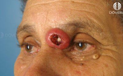 Grau de diferenciação do carcinoma espinocelular