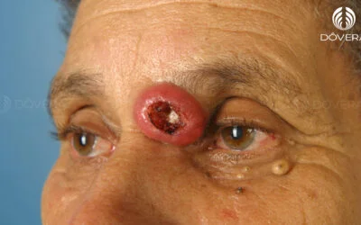 Grau de diferenciação do carcinoma espinocelular