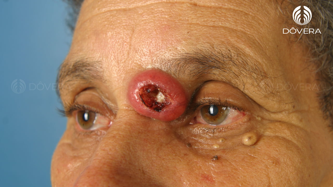 Carcinoma epidermóide grau 1