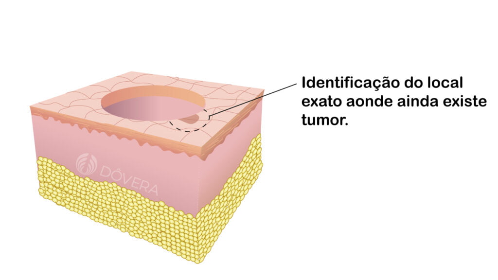 Identificação do local do tumor residual na cirurgia de Mohs