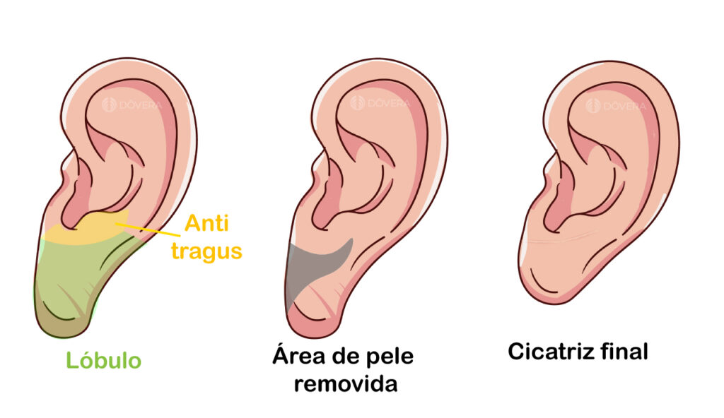 Lobulo Da Orelha Anexado Lóbulo Orelha Acoplado Lóbulo Orelha Livre