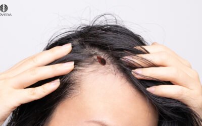 Melanoma de couro cabeludo