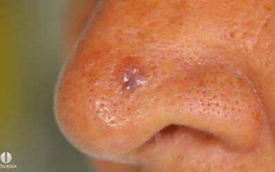 Carcinoma basocelular no nariz