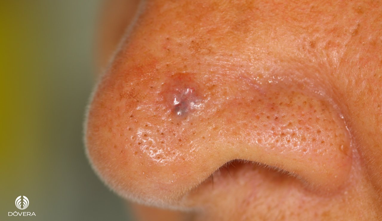Carcinoma basocelular em ponta nasal