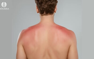 Me queimei no sol, e agora?