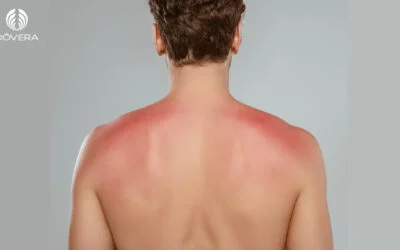 Me queimei no sol, e agora?