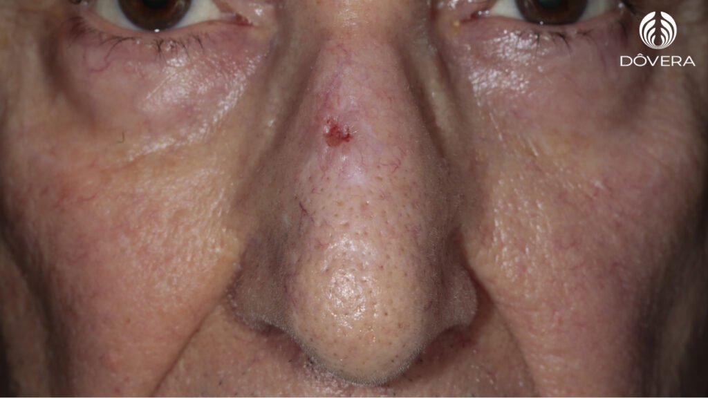 Carcinoma Basocelular Guia Completo
